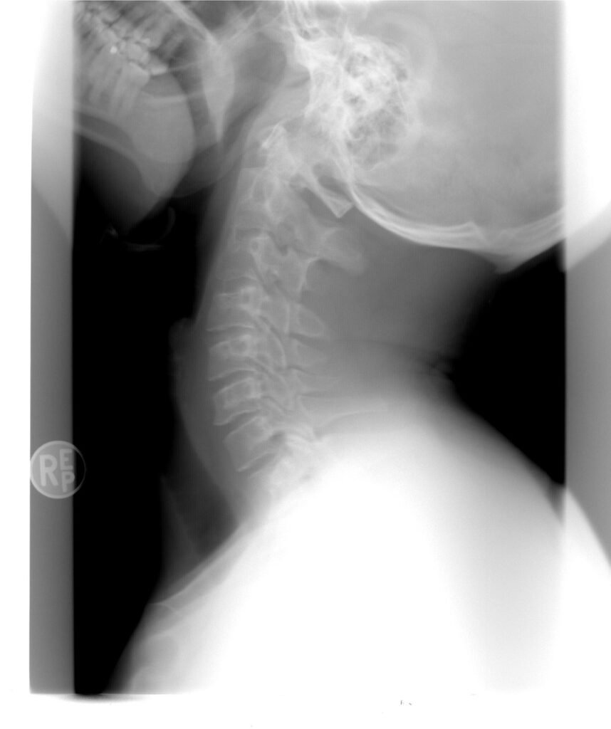 cervical spine x-ray